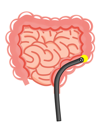 大腸カメライメージ
